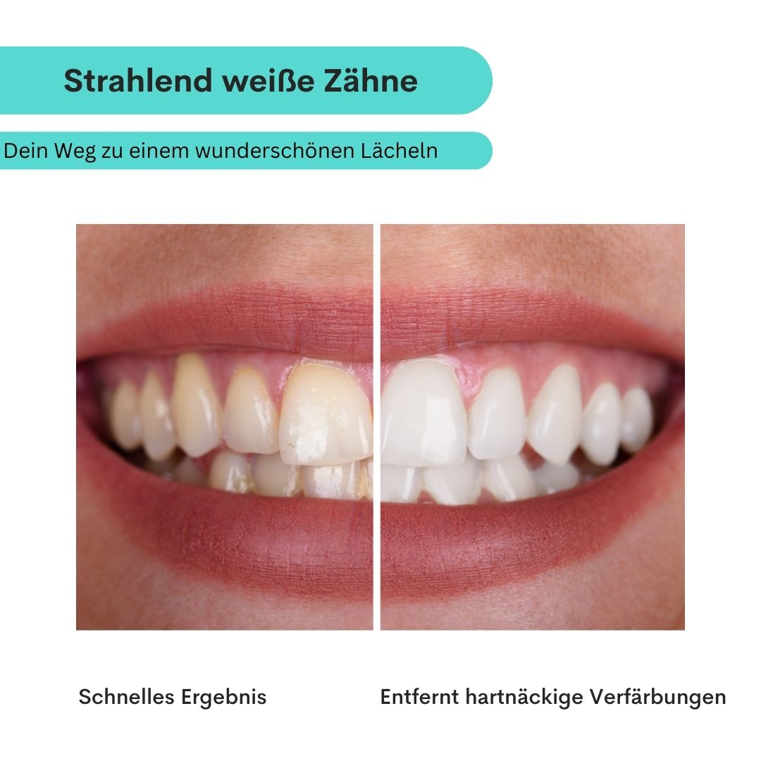 Zahnaufhellung Whitening Stripes
