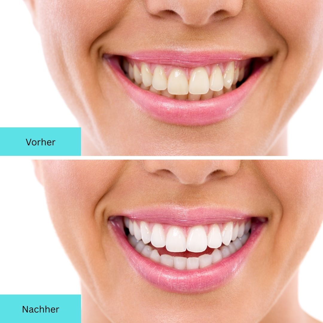 Zahnaufhellung Whitening Pen